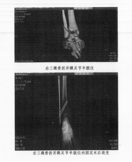 宿舍内抱摔致同学骨折，学校要赔吗？望城区法院：已尽管理职责，不担责！